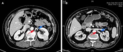 The feasibility and safety of adopting the left lumbar vein to localize the renal artery location during left transperitoneal laparoscopic partial nephrectomy